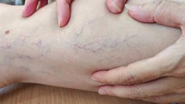 احذروا  مضاعفات دوالي الساقين