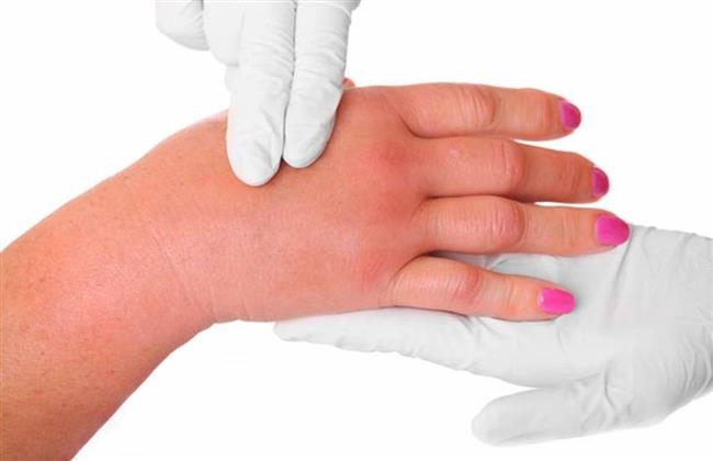 علامات وأسباب احتباس السوائل في الجسم