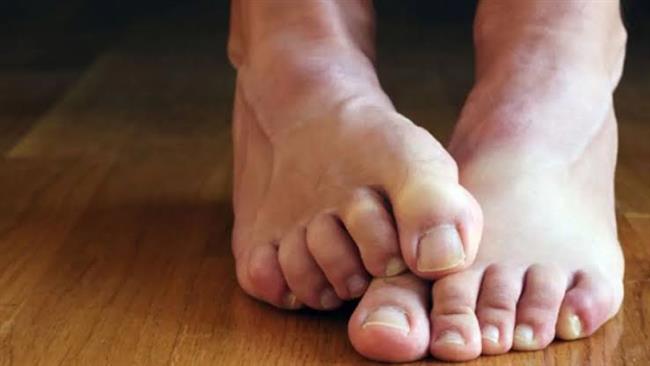 متلازمة تململ الساقين..الأسباب والأعراض