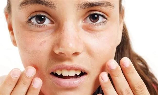 لوجه أكثر نضارة.. عادات صحية تساعد على تقليل امتلاء الخدين والذقن