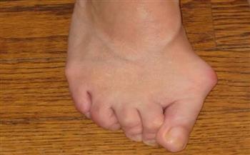 أسباب اعوجاج إبهام القدم وكيف يمكن علاجه؟